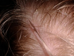 Natural Cure for Cradle Cap
