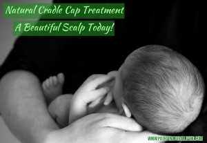 Natural Cradle Cap Treatment - Babies Hair will be beautiful again starting today